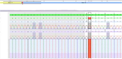 Case Report: Dubin-Johnson Syndrome Presenting With Infantile Cholestasis: An Overlooked Diagnosis in an Extended Family